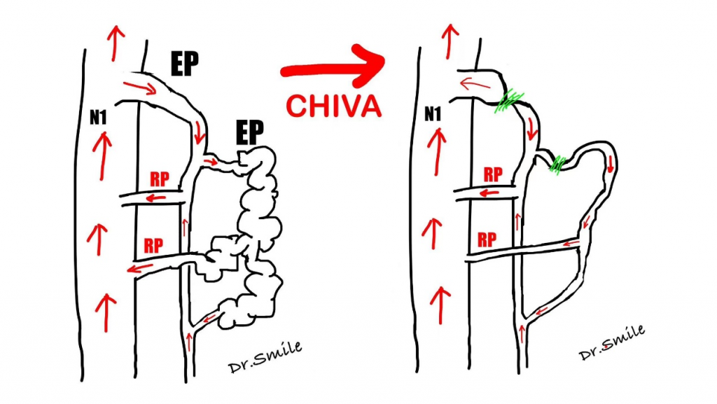 CHIVA Surgery A Comfortable Experience An Effective Treatment Chiva surgery a comfortable experience an effective treatment